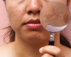 Особенности озонотерапии для лечения кожи лица Озон для лица до и после